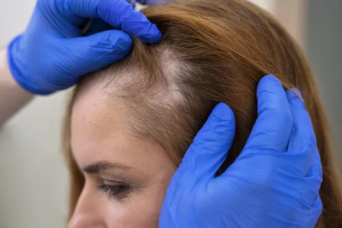 Alopecia areata: causas, tratamentos e risco de recaída